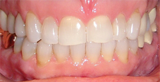 58 year old female treated with Invisalign