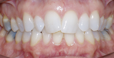 52 year old female treated with Invisalign