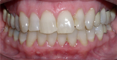 53 year old female treated with Invisalign