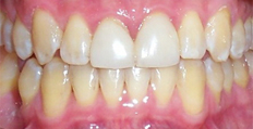 40 year old male treated with Invisalign