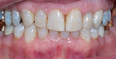 76 year old female treated with Invisalign 