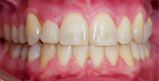 40 year old male treated with Invisalign