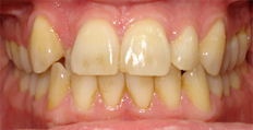 40 year old male treated with Invisalign