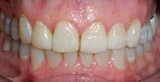 62 year old female treated with Invisalign