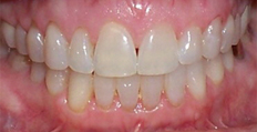 50 year old female treated with Invisalign