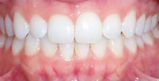 25 year old female treated with Invisalign