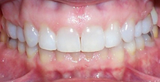 50 year old female treated with Invisalign Long term Stability