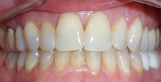 39 year old female treated with Invisalign