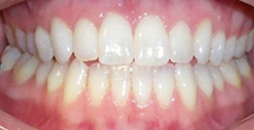 28 year old female treated with Invisalign