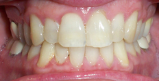 54 year old male treated with Invisalign