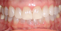 60 year old female treated with Invisalign