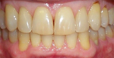 66 years old male treated with Invisalign