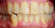 66 years old male treated with Invisalign