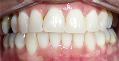 45 year old female treated with Invisalign