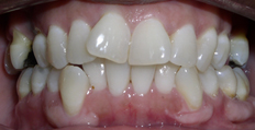 45 year old female treated with Invisalign