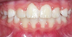 9 year old female treated with Braces, Phase 1 Treatment