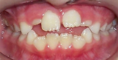 9 year old female treated with Braces, Phase 1 Treatment