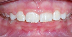 10 year old male treated with Braces , Phase 1 Treatment