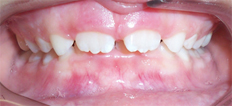 10 year old male treated with Braces, Phase 1 Treatment